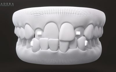 Invisalign Attachments
