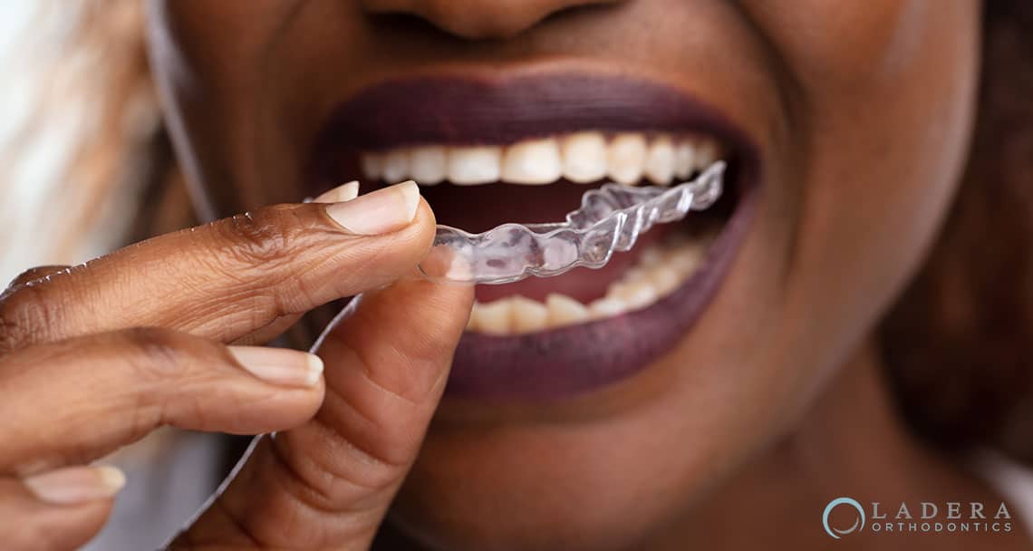 How Does Clear Aligner Therapy Actually Work?